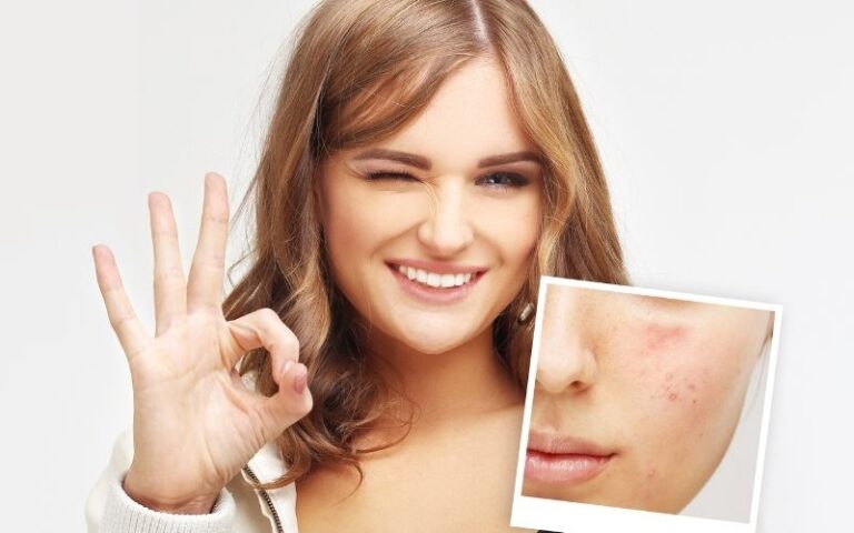 treatment for acne prone skin